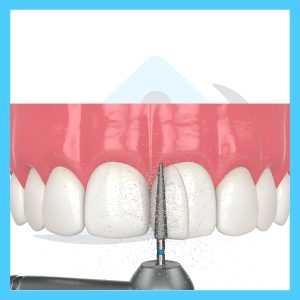 کامپوزیت دندان پزشکی هانا طب تهران