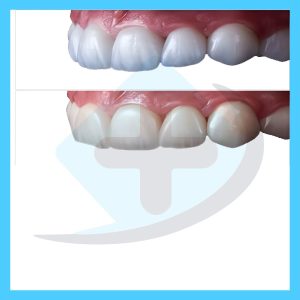 کامپوزیت دندان پزشکی هانا طب تهران