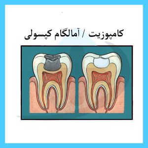 فرق کامپوزیت و آمالگام هانا طب تهران