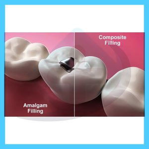 فرق کامپوزیت و آمالگام هانا طب تهران