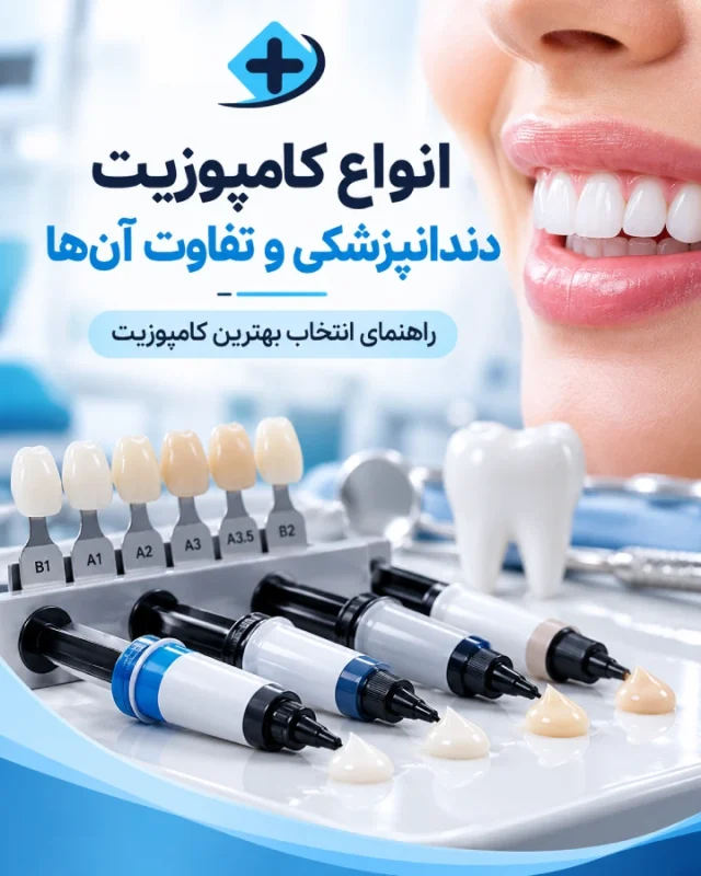انواع کامپوزیت دندانپزشکی و تفاوت آن‌ها؛ راهنمای انتخاب بهترین کامپوزیت